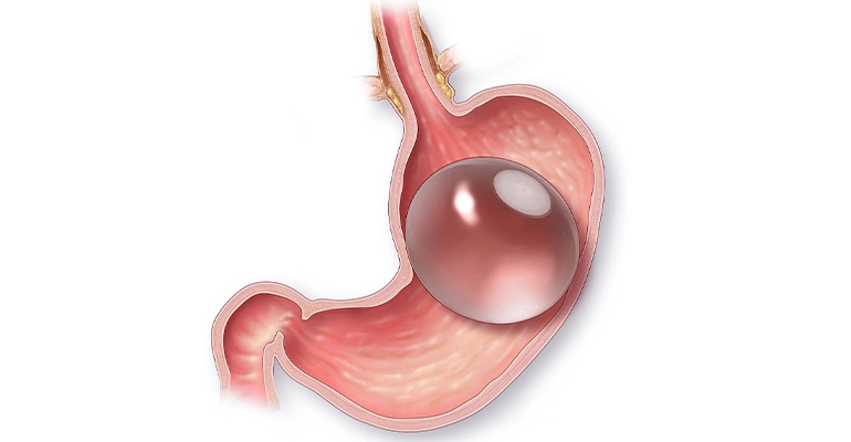 https://clinoraclinic.ghayatltd.com/wp-content/uploads/2026/06/materials/gastric- balloon/gastric-baloon.webp